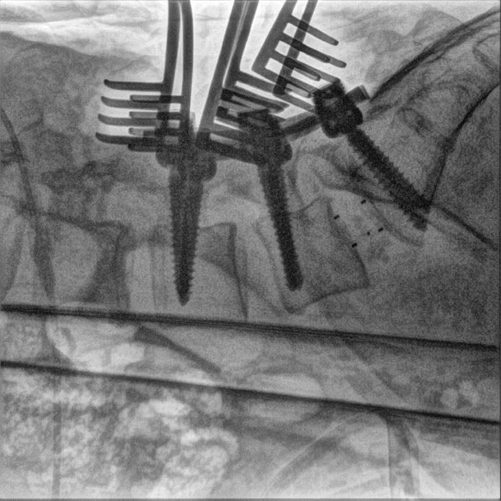 Hospital Raidology C Arm X-ray Machine